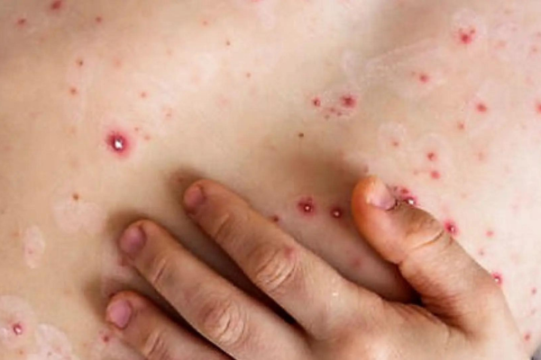 España intensifica la búsqueda de 20.000 personas sin vacunar contra la viruela del mono Imagen página web